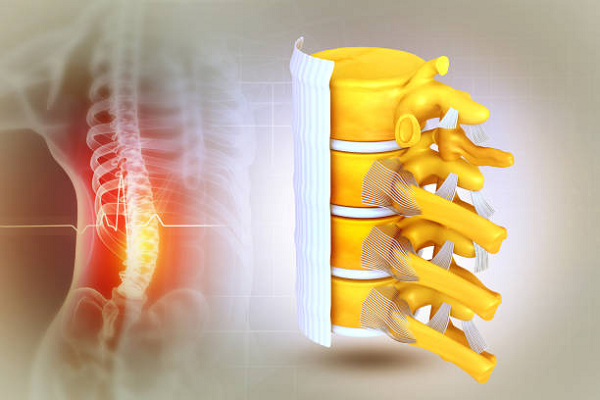 Spinal Tumors