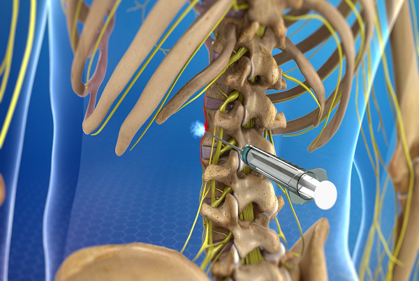 Nerve Blocks